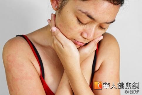 濕疹為皮膚過敏反應，通常會出現發紅、乾癢等症狀。
