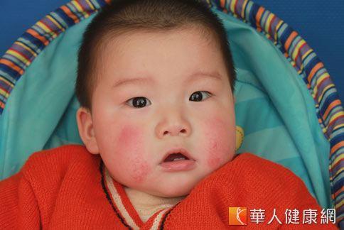 小兒濕疹為嬰兒時期常見的過敏性皮膚病之一。